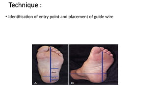 Technique :
• Identification of entry point and placement of guide wire
 