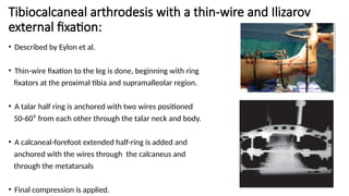 Tibiocalcaneal arthrodesis with a thin-wire and Ilizarov
external fixation:
• Described by Eylon et al.
• Thin-wire fixation to the leg is done, beginning with ring
fixators at the proximal tibia and supramalleolar region.
• A talar half ring is anchored with two wires positioned
50-60⁰ from each other through the talar neck and body.
• A calcaneal-forefoot extended half-ring is added and
anchored with the wires through the calcaneus and
through the metatarsals
• Final compression is applied.
 