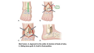 Blair fusion. A, Approach to the ankle. B, Excision of body of talus.
C, Sliding bone graft. D, Graft in final position.
 