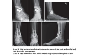 A and B, Total ankle arthroplasty with loosening, periarticular cyst, and medial and
lateral anterior impingement.
C and D, After arthrodesis with femoral head allograft and double-plate fixation
 