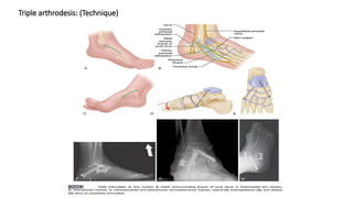 Triple arthrodesis: (Technique)
 
