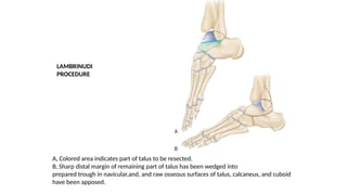 A, Colored area indicates part of talus to be resected.
B, Sharp distal margin of remaining part of talus has been wedged into
prepared trough in navicular,and, and raw osseous surfaces of talus, calcaneus, and cuboid
have been apposed.
LAMBRINUDI
PROCEDURE
 