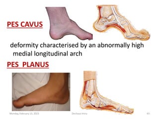 PES CAVUS
deformity characterised by an abnormally high
medial longitudinal arch
PES PLANUS
Monday, February 13, 2023 Dechasa Imiru 43
 