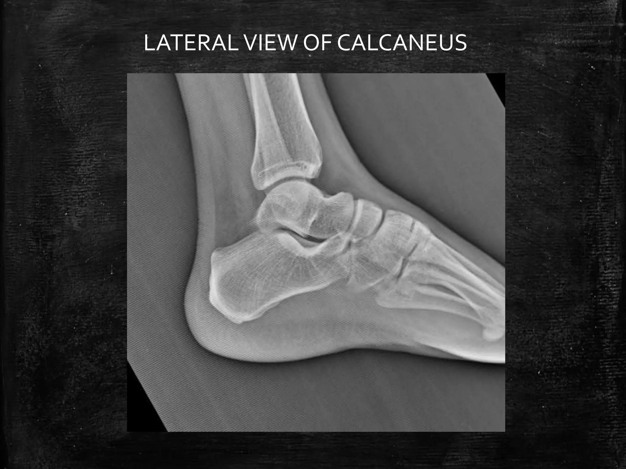 Normal Ankle and foot Radiographs by Dr Avinash | PPTX