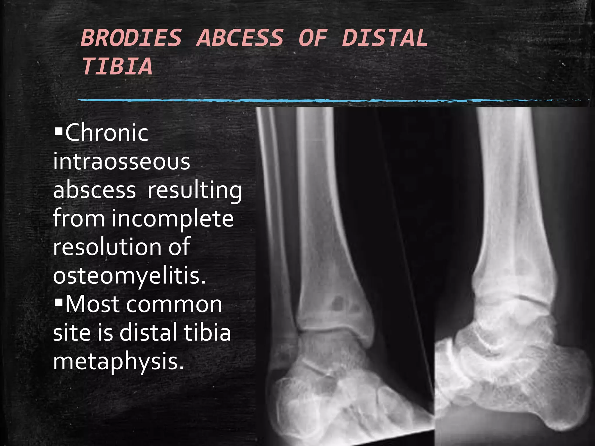 Normal Ankle and foot Radiographs by Dr Avinash | PPTX