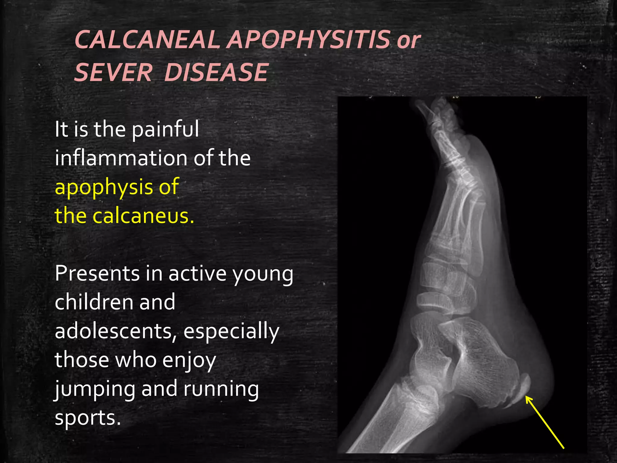 Normal Ankle and foot Radiographs by Dr Avinash | PPTX