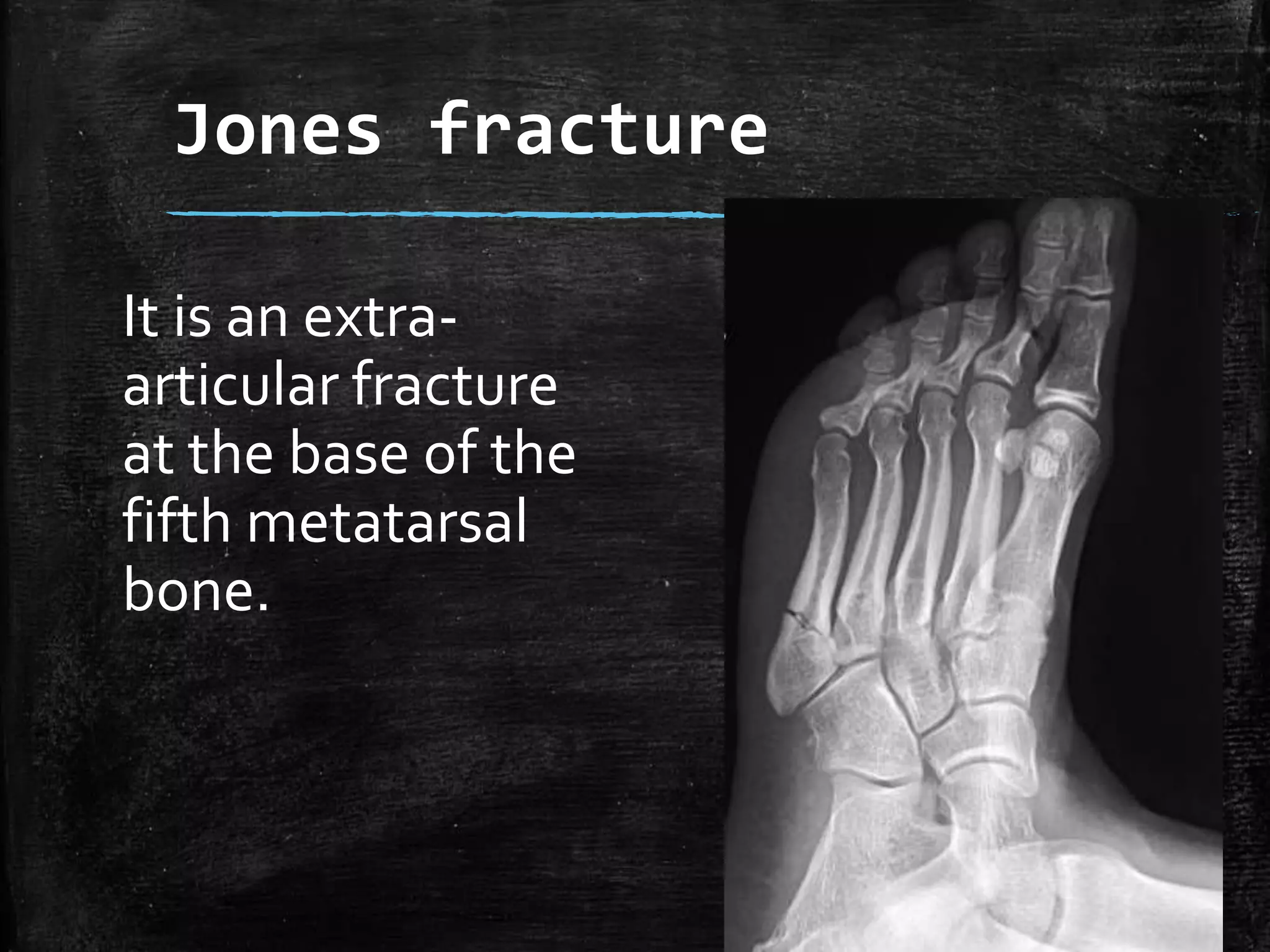 Normal Ankle and foot Radiographs by Dr Avinash | PPTX