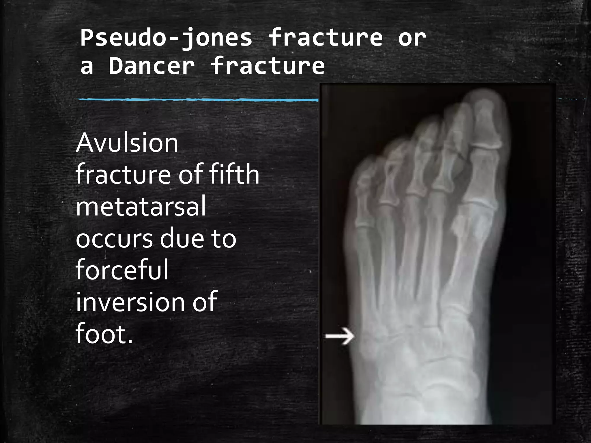 Normal Ankle and foot Radiographs by Dr Avinash | PPTX