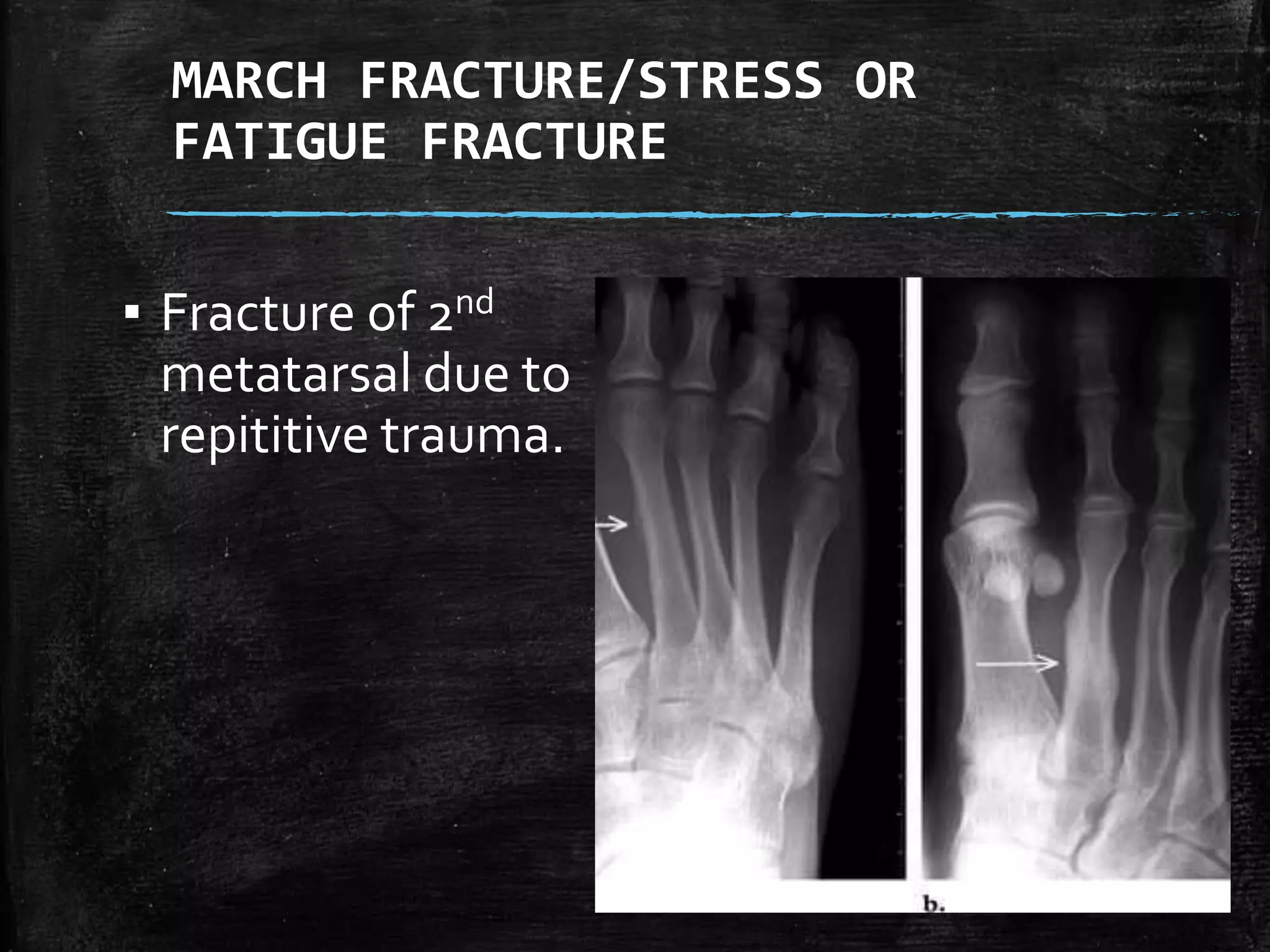 Normal Ankle and foot Radiographs by Dr Avinash | PPTX