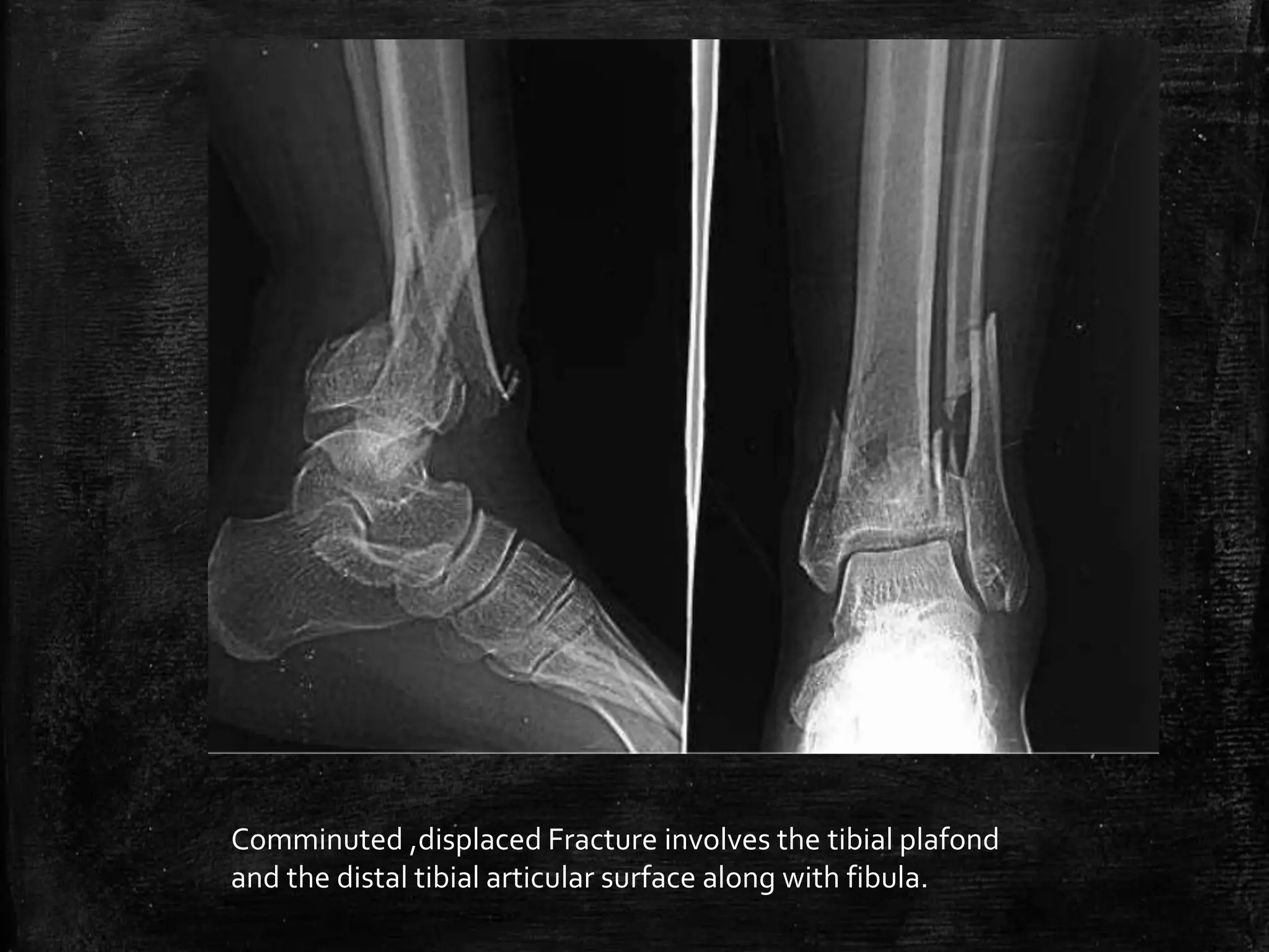 Normal Ankle and foot Radiographs by Dr Avinash | PPTX