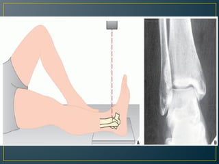 ankle and foot imaging and indications for it | PDF