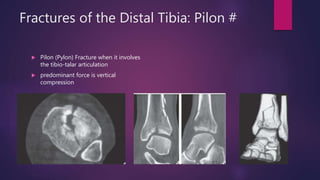 What Is Tibia Pilon Ankle and Foot | PPTX