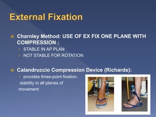  Charnley Method: USE OF EX FIX ONE PLANE WITH
COMPRESSION :
› STABLE IN AP PLAN
› NOT STABLE FOR ROTATION
 Calandruccio Compression Device (Richards):
› provides three-point fixation,
stability in all planes of
movement
 