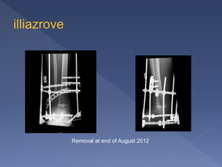 Removal at end of August 2012
 