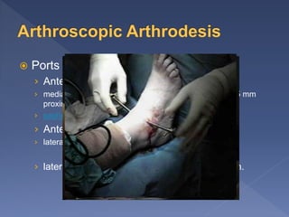  Ports 2 or 3
› Anteromedial:
› medial to the tibialis nterior tendon, and located about 5 mm
proximal to the medial malleolus
› saphenous nerve and vein
› Anterolateral:
› lateral to peroneus tertius tendon
› lateral to the extensor digitorum longus tendon.
 
