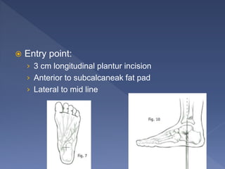  Entry point:
› 3 cm longitudinal plantur incision
› Anterior to subcalcaneak fat pad
› Lateral to mid line
 