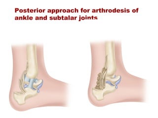 Ankle and foot arthrodesis | PPT