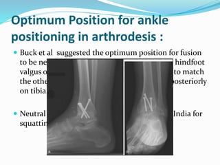 Optimum Position for ankle
positioning in arthrodesis :
 Buck et al suggested the optimum position for fusion
to be neutral or slight dorsiflexion of 5°, mild hindfoot
valgus of 5° to 8°, external rotation of 5 to 10° to match
the other foot and slight translation of talus posteriorly
on tibia.
 Neutral or slight dorsiflexion is important in India for
squatting for toilet
 