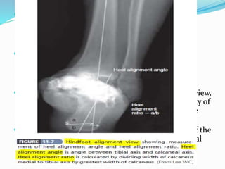  Evaluate the hind foot joints , talonavicular joint
because it is responsible for most of the ankle
movement after ankle arthrodesis.
 Radiographic evaluation : The hindfoot alignment
view can assist in assessing deformity distal to the
ankle joint.
 Amount of joint space loss on the anteroposterior view,
coronal plane deformity should be assessed. Quality of
bone stock and any cysts or other defects should be
noted.
 On the lateral view, anteroposterior subluxation of the
ankle should be noted, as well as any tilt of the tibial
plafond
 
