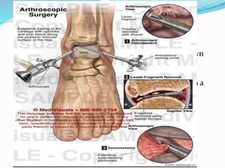 Arthroscopic debridement : Efficacy has been shown
in a number of studies for the removal of anterior
impingement osteophytes from the tibia or talus.
Patients with mechanical locking of the ankle from a
demonstrable loose body may also benefit from
arthroscopic management, but it is likely that the
debridement of more advanced arthritic ankles
provides only short-term relief.
 