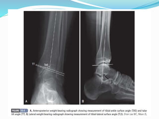  For determination of involvement of compartment of
tibial articular surface for supramalleolar corrective
osteotomy.
 TIBIO- TALAR AXIS
 TIBIAL LATERAL SURFACE ANGLE.
 