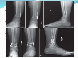  Tibial osteotomy incision done 5cm from tip of medial
malleolus an 8cm incision is done .
 Make a osteotomy 5cm from tip of the medial
malleolus with leaving an intact lateral cortex.
 Insert a prepared wedge bone graft & apply a 4-8 holed
plate after contouring. Followed by fixation of fibular
osteotomy with a plate fixation.
 