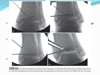  with a wide osteotome gradually bend the plafond until the
medial tibial articular surface is parallel to the intact
portion of the distal lateral tibia.
 Insert a lamina spreader into the cortical gap to hold the
correction while allograft cancellous bone chips are
inserted into the defect under fluoroscopic guidance to
maintain a parallel joint surface.
 Secure the osteotomy with a locking plate to serve as a
buttress to ensure that the allograft remains in place.
 