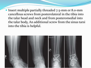  Insert multiple partially threaded 7.5-mm or 8.0-mm
cancellous screws from posterolateral in the tibia into
the talar head and neck and from posteromedial into
the talar body, An additional screw from the sinus tarsi
into the tibia is helpful.
 