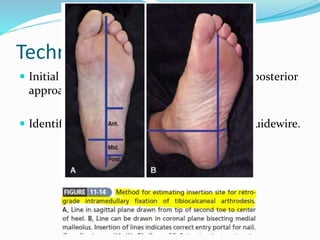 Technique ..
 Initial preparation of joint can be done using posterior
approach providing wider exposure.
 Identification of entry point & placement of guidewire.
 