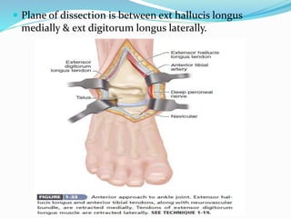  Plane of dissection is between ext hallucis longus
medially & ext digitorum longus laterally.
 