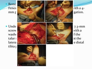  Remove cartilage synovium and loose bodies.
Fenestrate subchondral tibial and talar bone with a 4-
mm powered burr at low speed with saline irrigation.
 Under fluoroscopic guidance, pass two 6.5- or 7.3-mm
screws from lateral to medial. Pass one screw with a
washer in an anterior position from the base of the
talar neck to the tibia. Start the second screw at the
lateral process of the talus and direct it into the distal
tibia posteriorly.
 