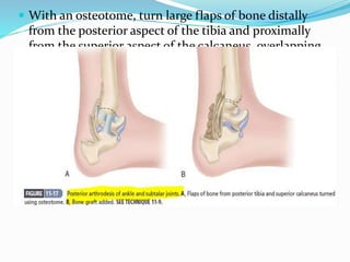  With an osteotome, turn large flaps of bone distally
from the posterior aspect of the tibia and proximally
from the superior aspect of the calcaneus, overlapping
them successively
 Additional bone grafts can be used
 Fixation can be accomplished with an intramedullary
nail or a posteriorly applied locking plate.
 