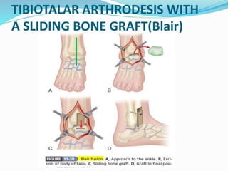 TIBIOTALAR ARTHRODESIS WITH
A SLIDING BONE GRAFT(Blair)
 