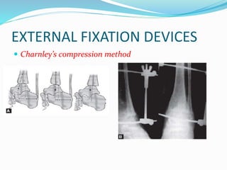 EXTERNAL FIXATION DEVICES
 Charnley’s compression method
 