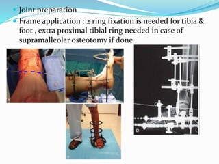  Joint preparation
 Frame application : 2 ring fixation is needed for tibia &
foot , extra proximal tibial ring needed in case of
supramalleolar osteotomy if done .
 