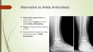 Alternative to Ankle Arthrodesis
 Total ankle replacement is a
type of joint
replacement surgery. It's also
called ankle arthroplasty.
 Trials are ongoing about efficacy
of TAR.
 Still preferred modality for ankle
arthritis and pain is Ankle
Arthrodesis.
 