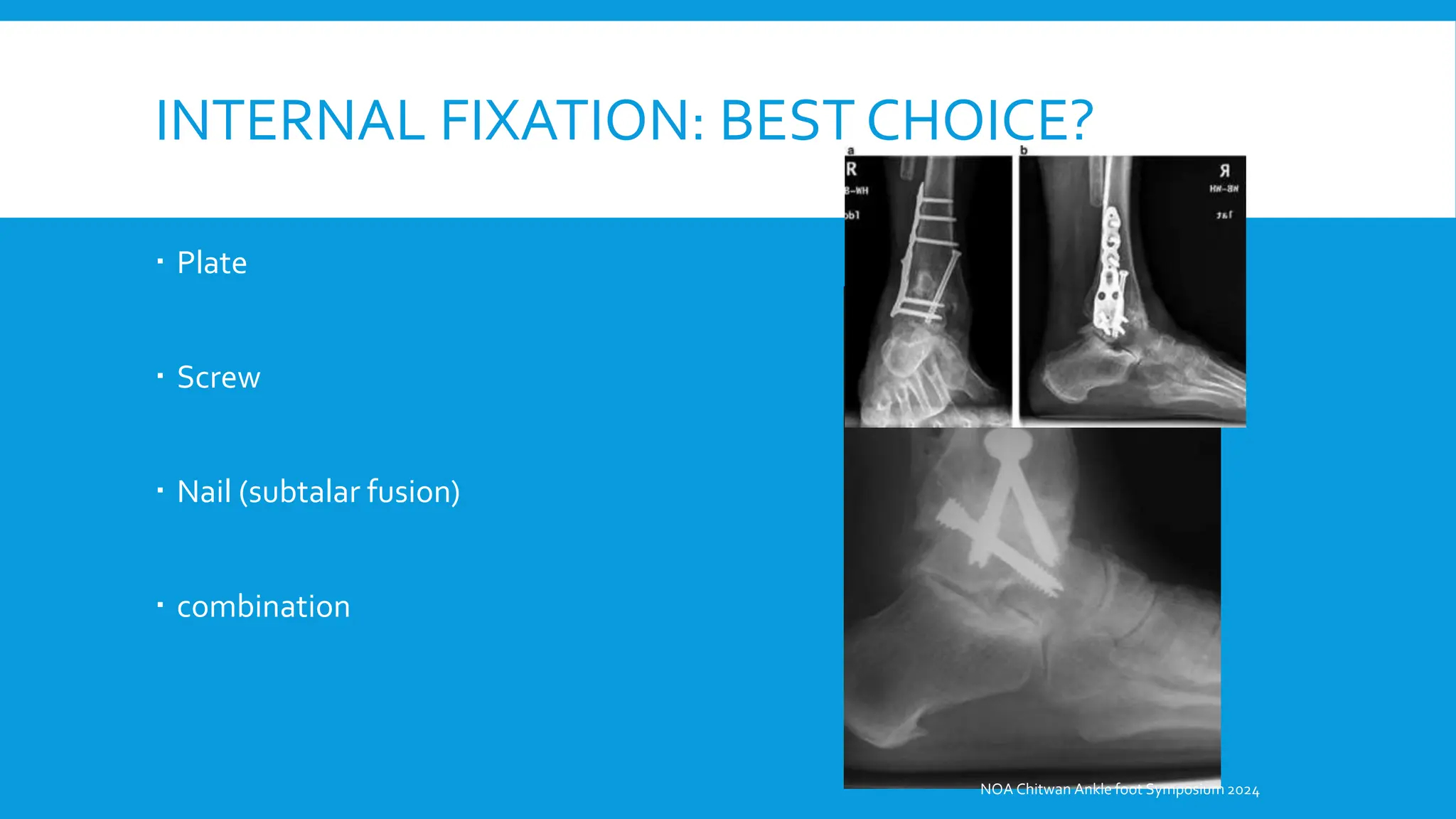 Ankle Arthrodesis, Approach and Surgical Techniques.pptx