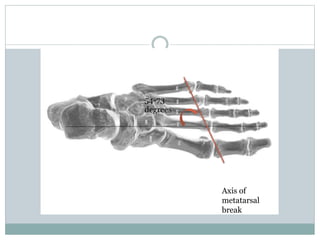 Axis of
metatarsal
break
54-73
degrees
 