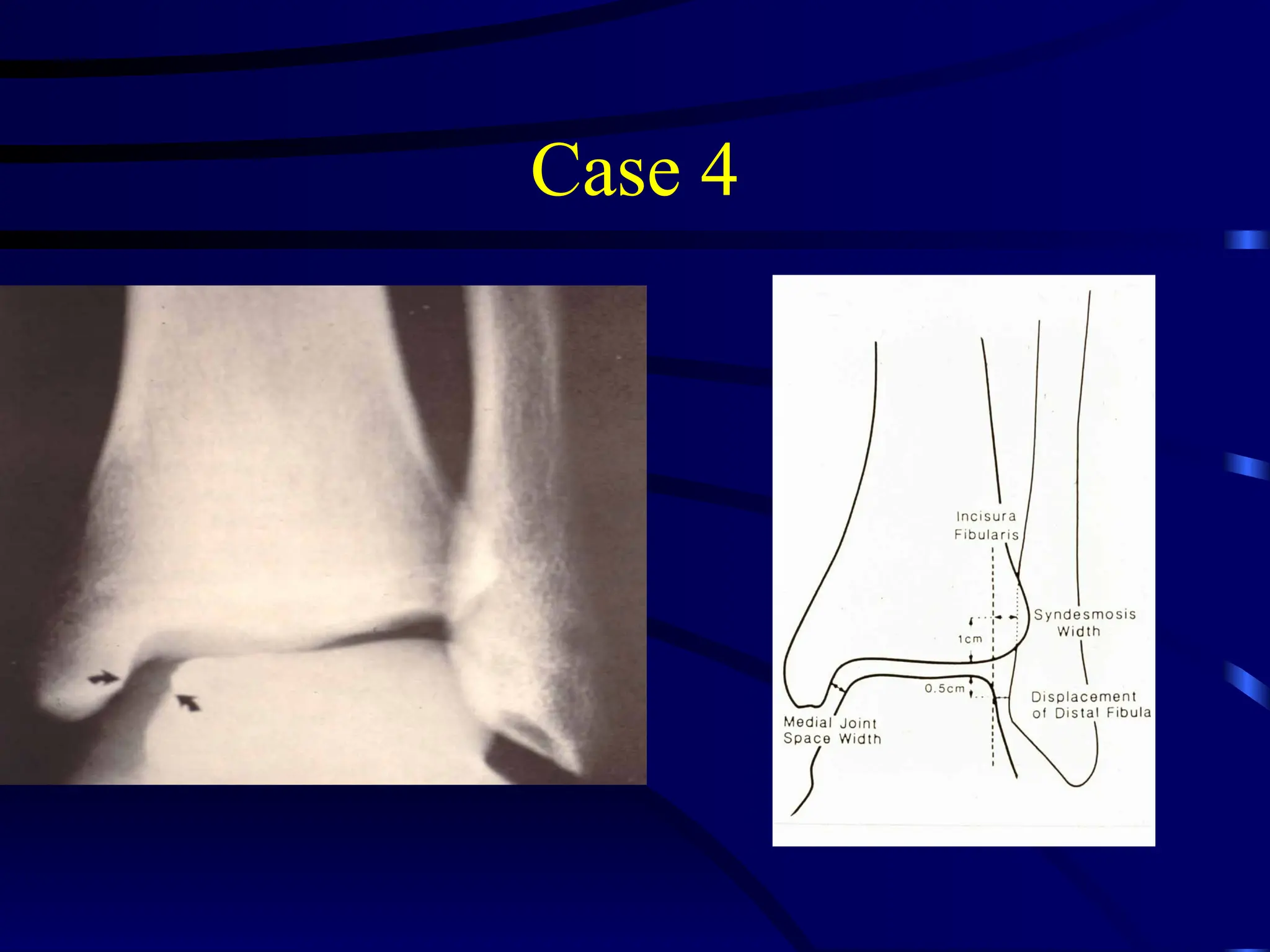 ankle and foot injuries-evaluation and management | PPT