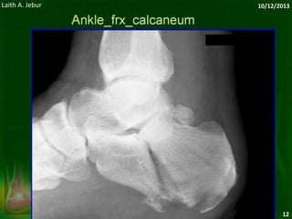 Ankle & foot x rays | PPSX