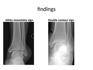 Ankle fracture presentation _045240.pptx