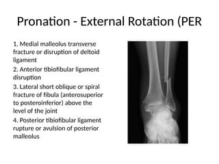 Ankle fracture presentation _045240.pptx