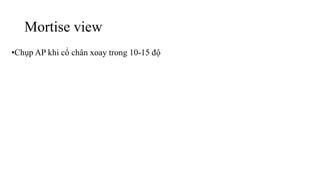 Mortise view
•Chụp AP khi cổ chân xoay trong 10-15 độ
 