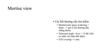 Mortise view
• Các bất thường cần tìm kiếm:
• Medial joint space widening >
4mm --> gợi ý tổn thương dây
chằng denta
• Talocural angle <8 or > 15 độ ( khi
so sánh với chân đối diện)
• Ti/Fi overlap <1 mm
 