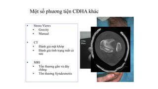 Một số phương tiện CĐHA khác
• Stress Views
• Gravity
• Manual
• CT
• Đánh giá mặt khớp
• Đánh giá tình trạng mắt cá
sau
• MRI
• Tổn thương gân và dây
chằng
• Tổn thương Syndesmotis
 
