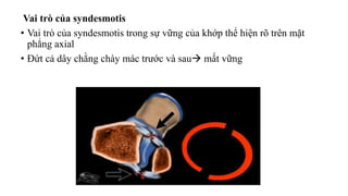 Vai trò của syndesmotis
• Vai trò của syndesmotis trong sự vững của khớp thể hiện rõ trên mặt
phẳng axial
• Đứt cả dây chằng chày mác trước và sau mất vững
 