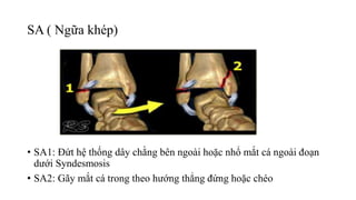 SA ( Ngữa khép)
• SA1: Đứt hệ thống dây chằng bên ngoài hoặc nhổ mắt cá ngoài đoạn
dưới Syndesmosis
• SA2: Gãy mắt cá trong theo hướng thẳng đứng hoặc chéo
 