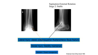 Supination-External Rotation
Stage 2: Stable
Standard: Closed management
Lateral Injury: classic posterosuperioranteroinferior fibula fracture
Medial Injury: Stability maintained
Kristensen Acta Orthop Scand 1985
 