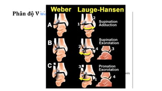 Phân độ Weber và Lauge Hansen giản lược
 