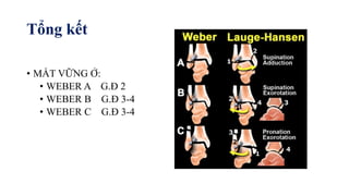 Tổng kết
• MẤT VỮNG Ở:
• WEBER A G.Đ 2
• WEBER B G.Đ 3-4
• WEBER C G.Đ 3-4
 